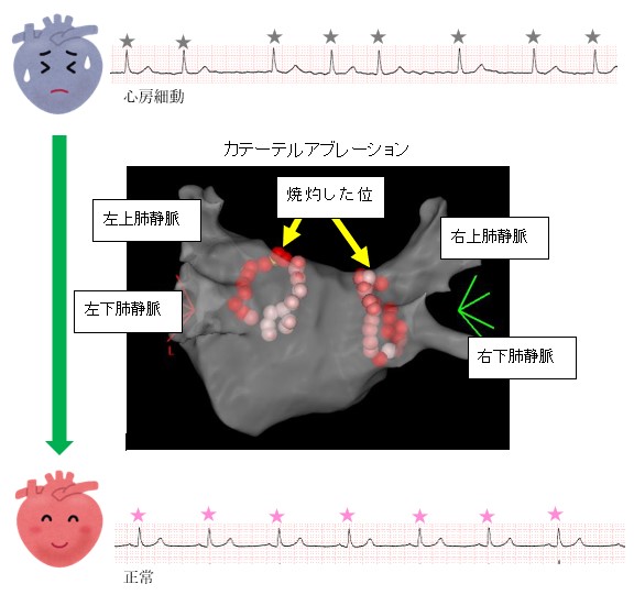 カテーテル アブレーション 費用