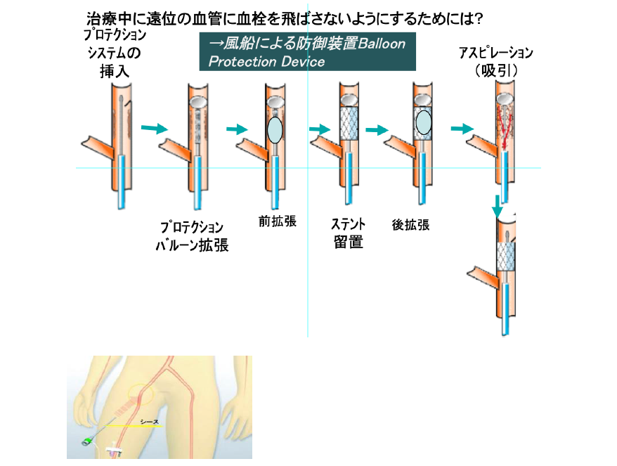 頸動脈ステント留置術からの回復はどのようなものですか?